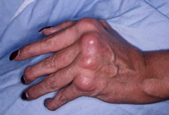plaque psoriasis treatment medscape