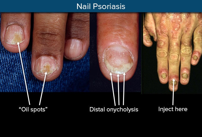 Psoriasis: Presentation, Imitators, and Treatment