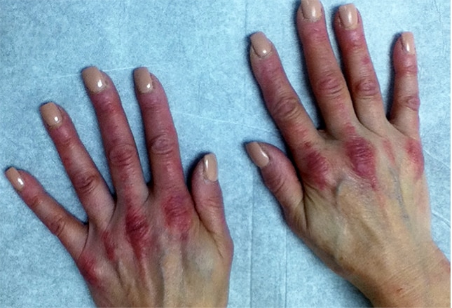 Diagnosing and Treating Rheumatic Skin Disorders