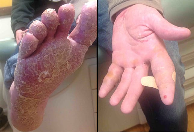 Diagnosing And Treating Rheumatic Skin Disorders
