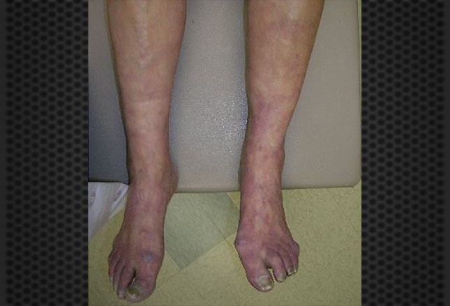 32++ Anfangsstadium rheuma fuesse bilder , Diagnosing and Treating Rheumatic Skin Disorders