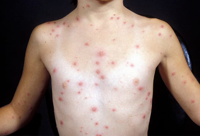 Back-to-School Viral Illnesses: 7 Classroom Contagions