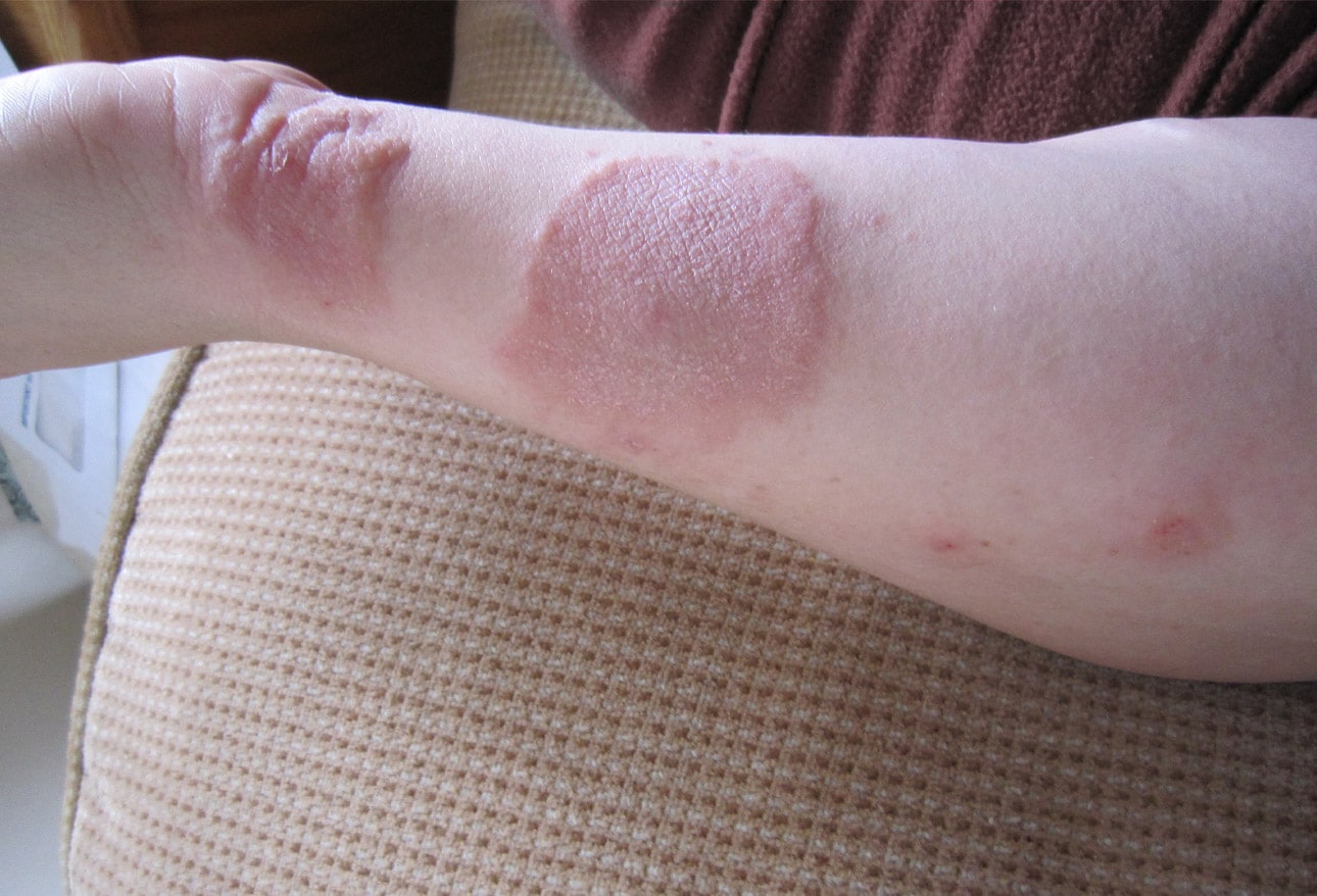 Scuba Diving Injuries and Underwater Hazards