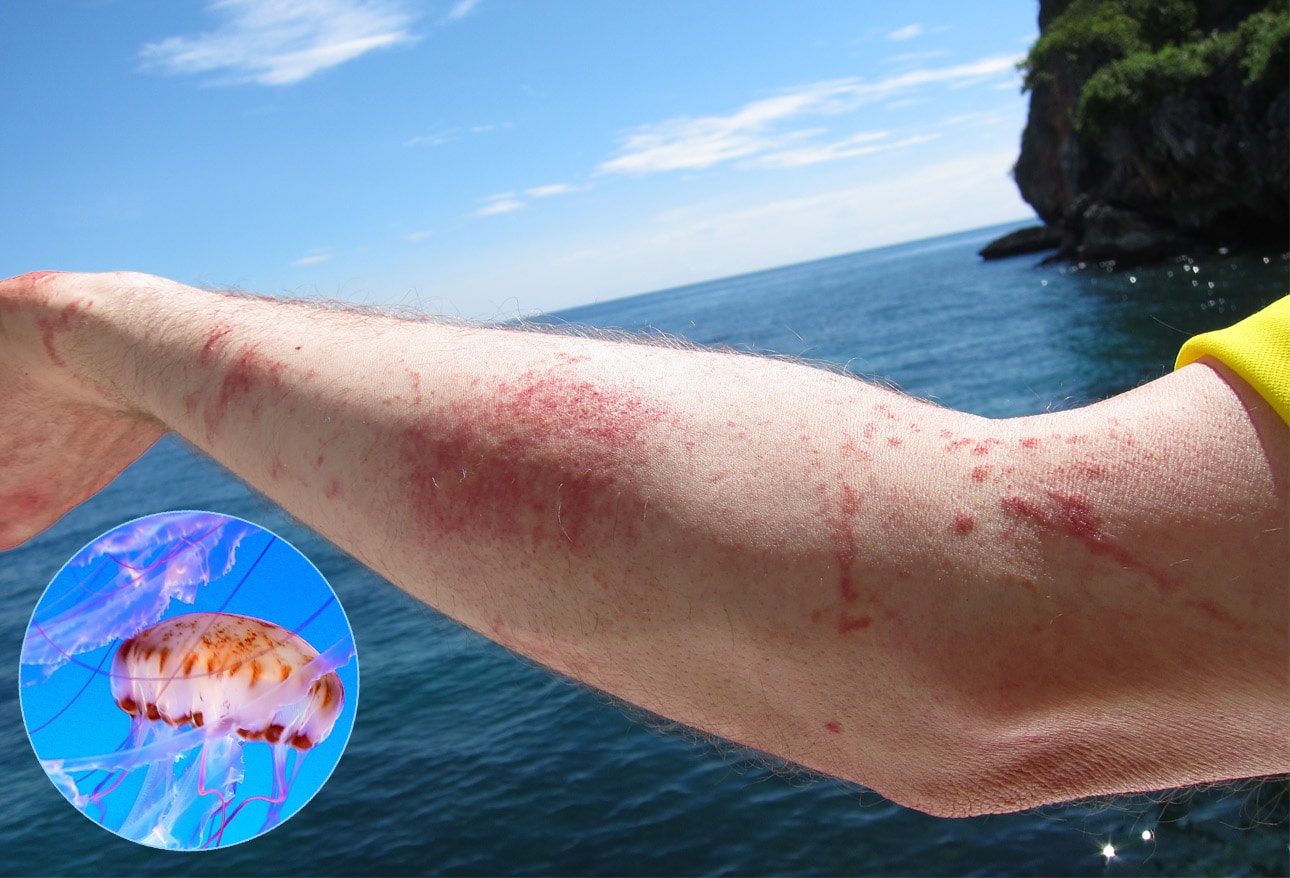 Scuba Diving Injuries and Underwater Hazards