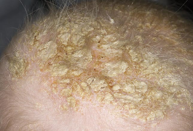 11-common-to-rare-infant-skin-conditions