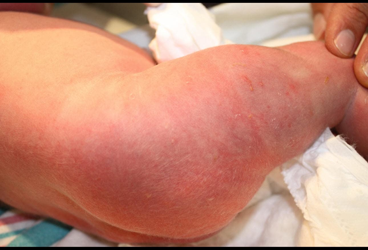 17 Most Common Types of Baby Rashes: With Pictures