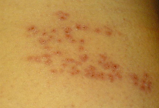 single flat red spots on skin maculey