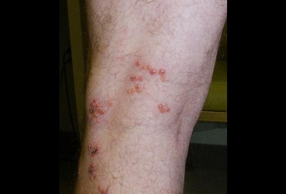 Cat Allergy Rash On Legs
