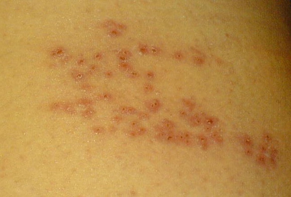 13 Pictures of Common Skin Rashes