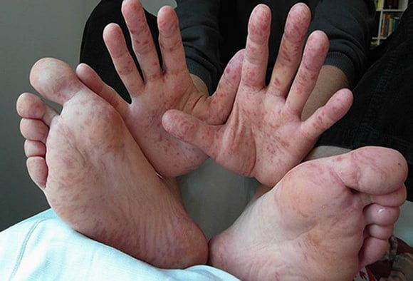 File:Feet with six toes on each.jpg - Wikimedia Commons