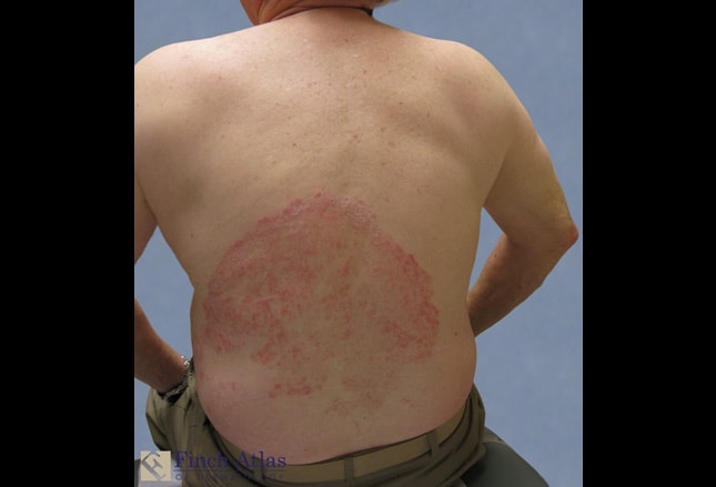 Eight Skin Rashes You Need to Know