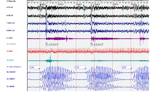 Sleep Disorders: Rest That Does Not Refresh