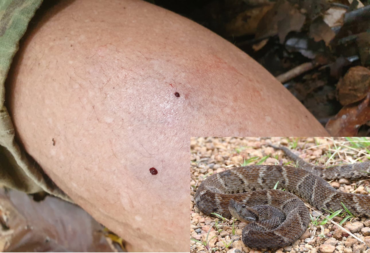 Snake Envenomations More Than Just A Bite