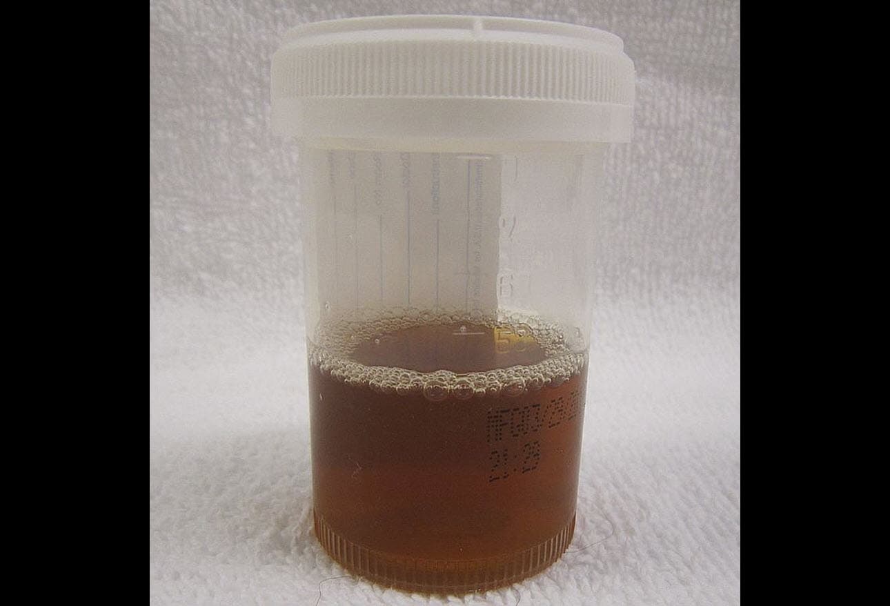 Snake Envenomations More Than Just a Bite