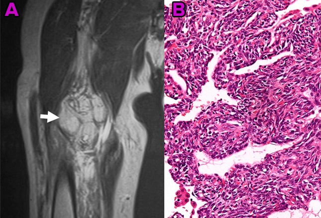 Soft-Tissue Sarcomas: What You Need To Know