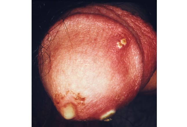 Signs of 9 Sexually Transmitted Diseases