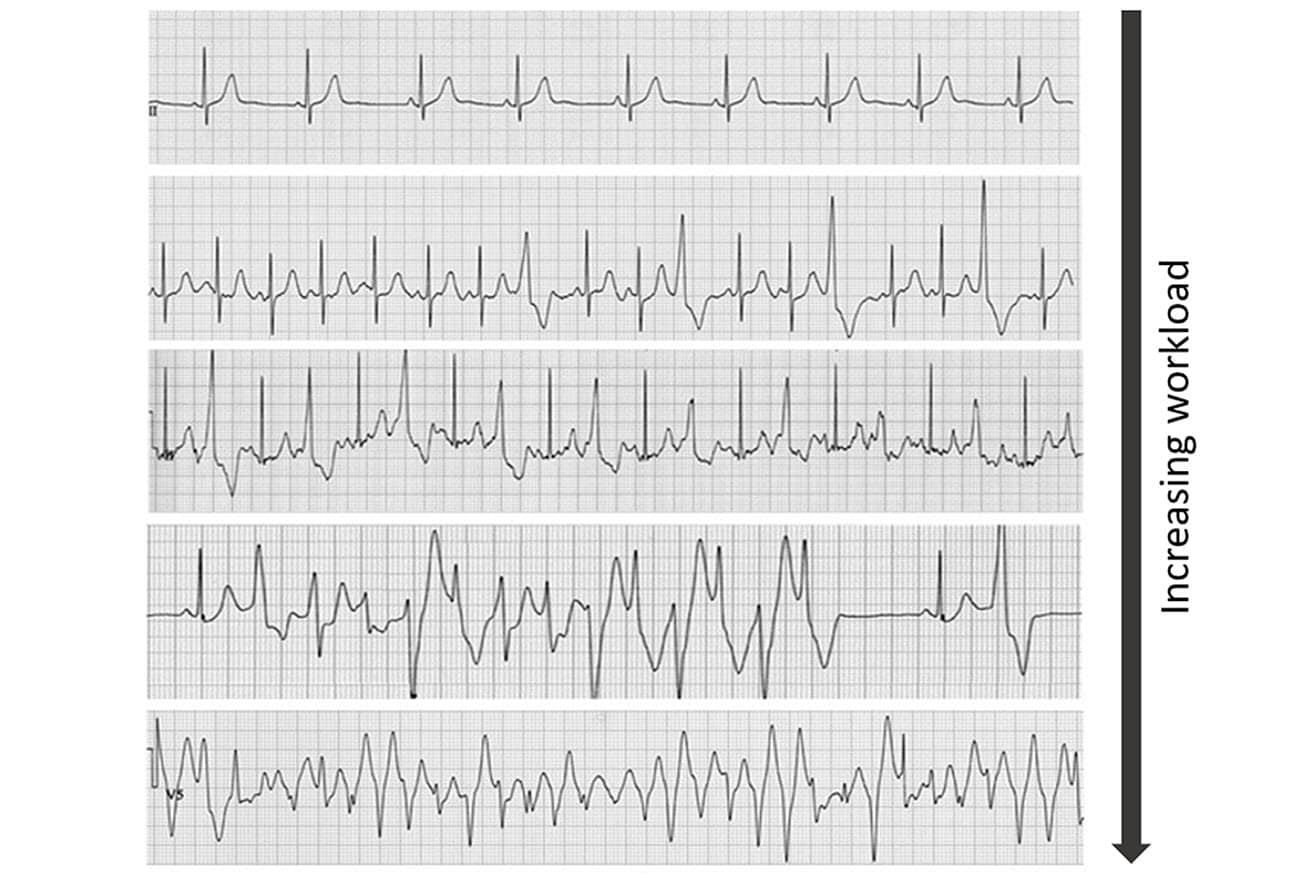 Sudden Cardiac Death