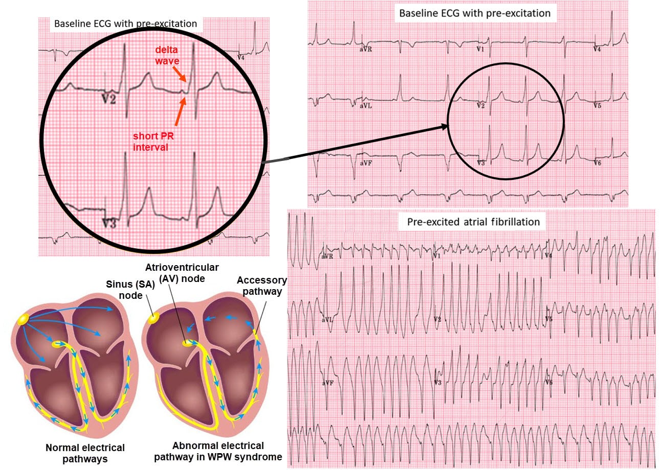 Sudden Cardiac Death