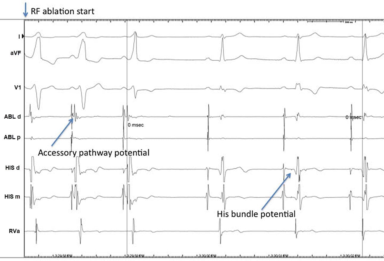 Sudden Cardiac Death