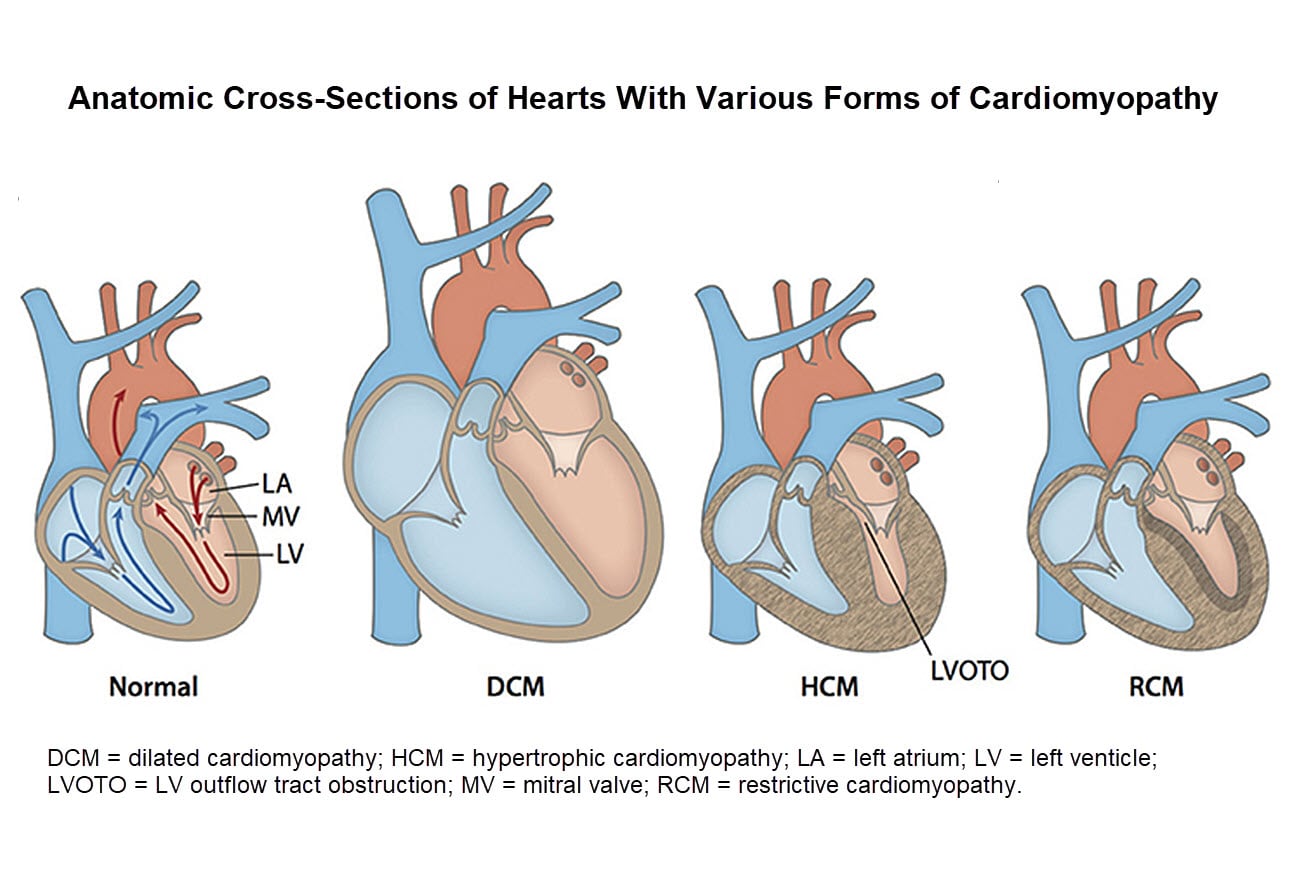 Sudden Cardiac Death