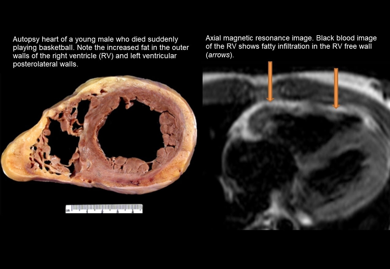 sudden-cardiac-death