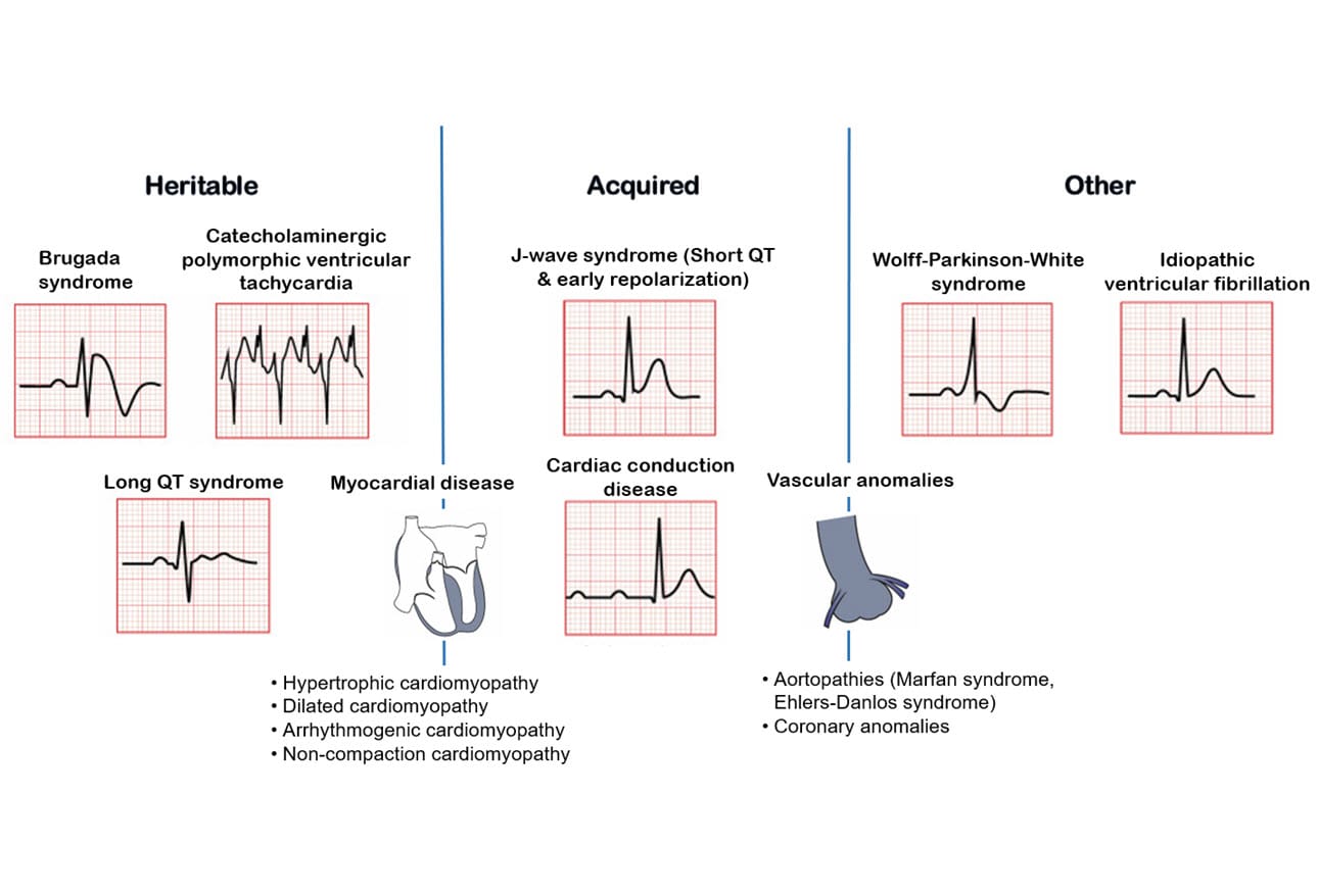 Sudden Cardiac Death