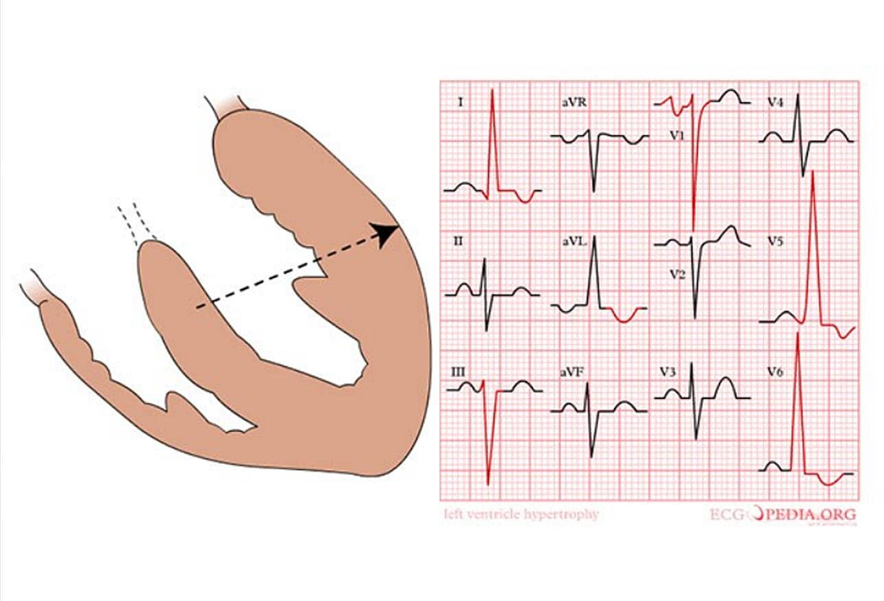 Sudden Cardiac Death in Athletes