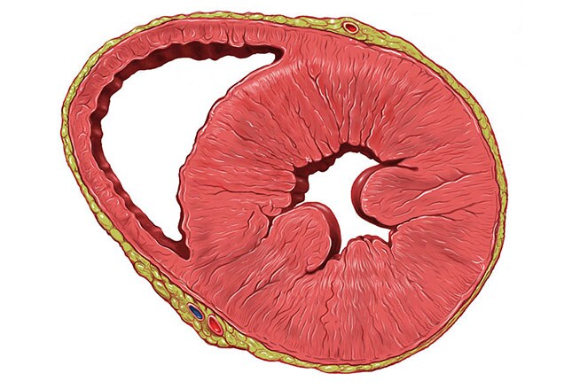 sudden cardiac death in athletes