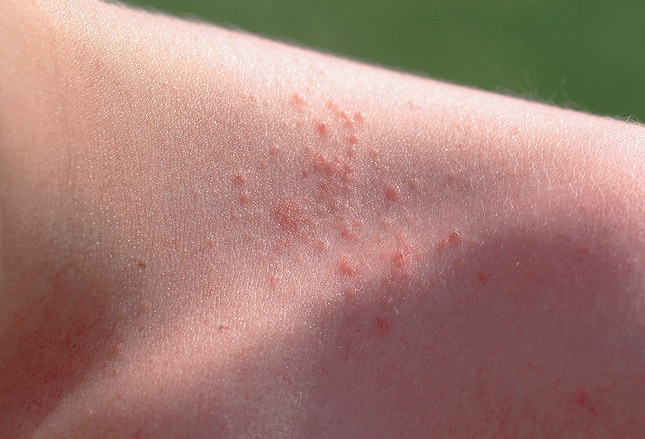 Kids Do the Darnedest Things: Summertime Injuries and Maladies, covid 19 skin rash pics