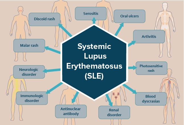 Systemic Lupus Erythematosus: Diverse And Difficult To Diagnose