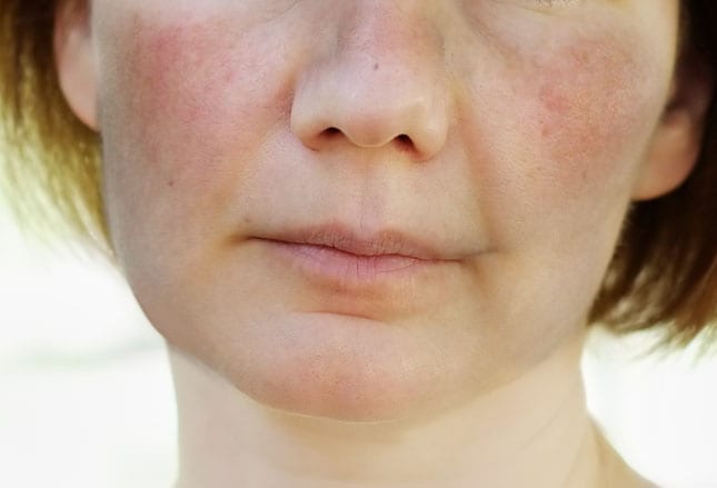 A 45-year-old woman presents with a skin rash on the face, chest, and arms....