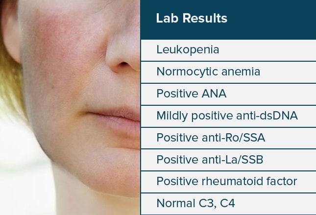Systemic Lupus Erythematosus Diverse And Difficult To Diagnose