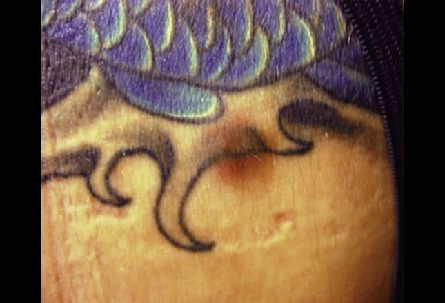 Tattoo Skin Reactions: Allergies and Infections