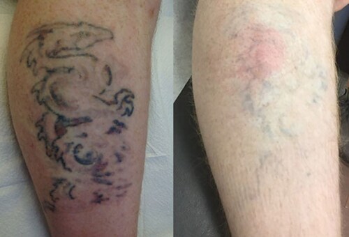tattoo skin reactions allergies and infections tattoo skin reactions allergies and infections
