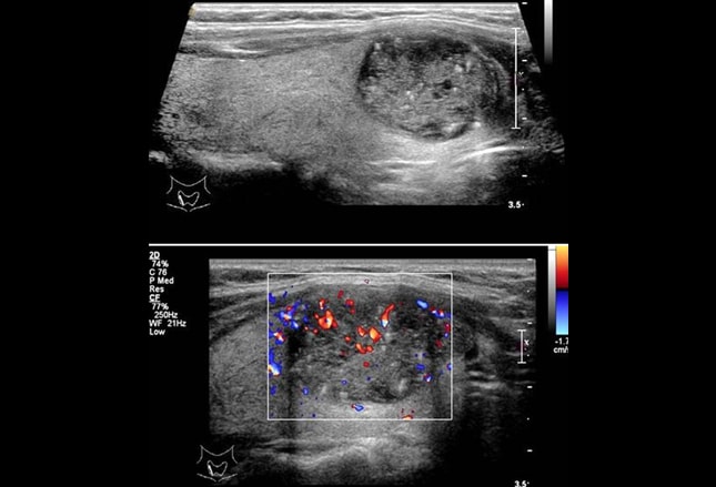 A Lump in the Throat: Thyroid Cancer