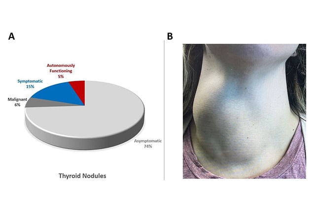 Shrinking Thyroid Nodules With Radiofrequency Ablation