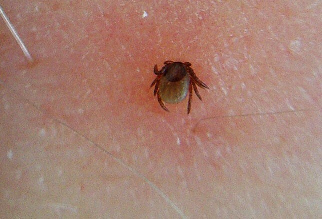 lyme disease and 4 emerging tick-borne illnesses