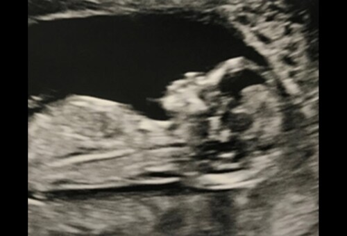 Don T Bump The Bump Trauma In Pregnancy