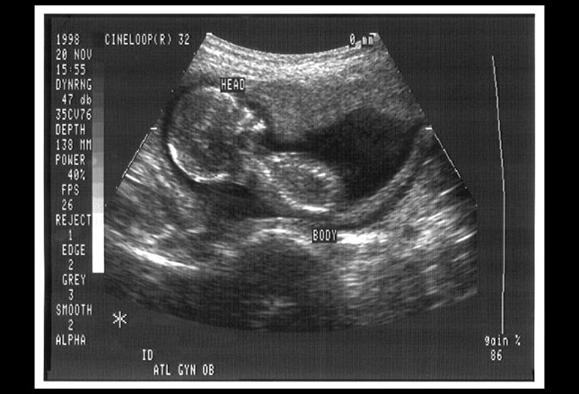 Medication induced fetal bladder rupture: a case report