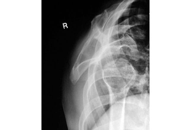 Dislocation risk and 90 degree rule