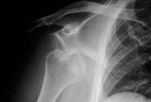 Dislocation risk and 90 degree rule