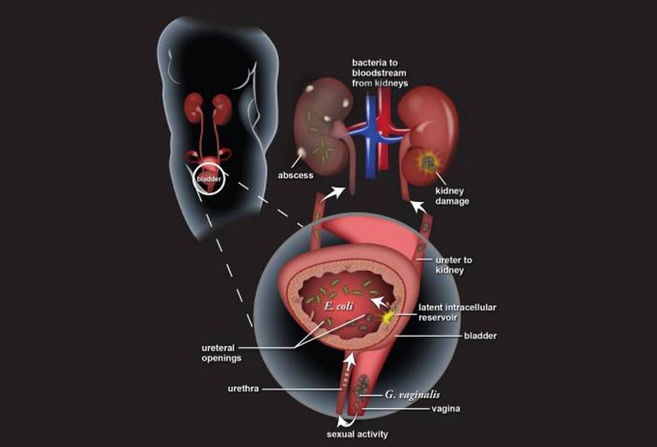 Urinary Tract Infections A Spectrum Of Pathologies And Challenges