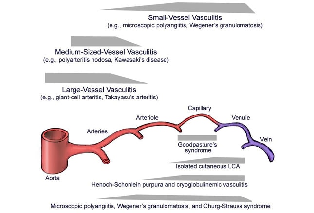 Vasculitis Vessel Size Matters   Fig2 