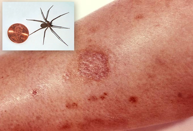 long bodied cellar spider bite mark