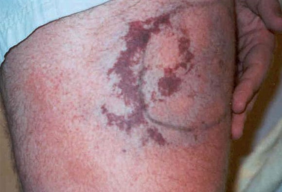 File:Groin Rash (right leg).JPG - Wikipedia