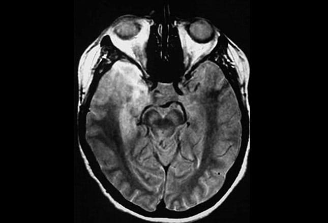 Central Vertigo: Identifying the Hidden Cause