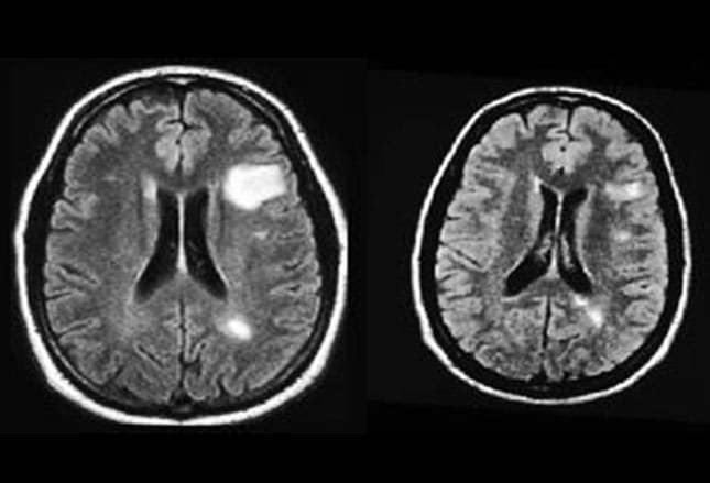 Central Vertigo: Identifying the Hidden Cause