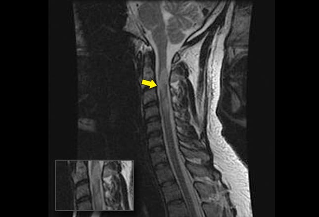 Central Vertigo: Identifying the Hidden Cause
