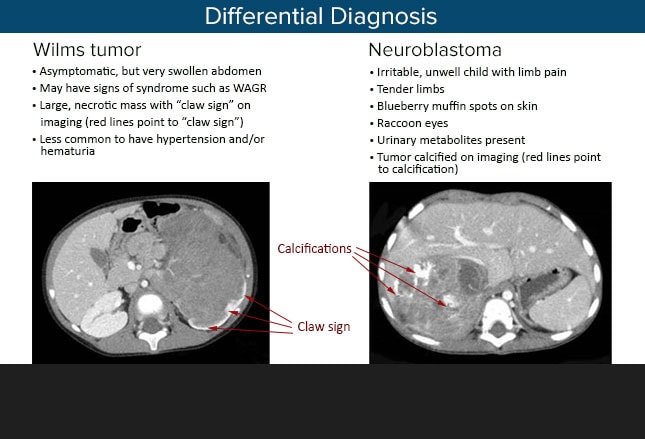 The table shows how to clinically differentiate between Wilms tumor and neu...