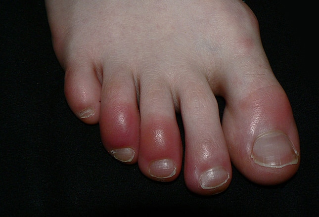 File:Frostbite palmar surface feet.jpg - Wikipedia